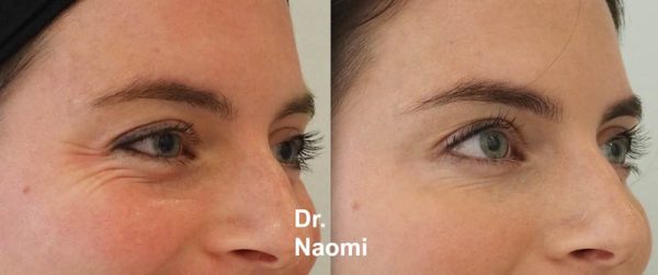 Treatment for eye wrinkles