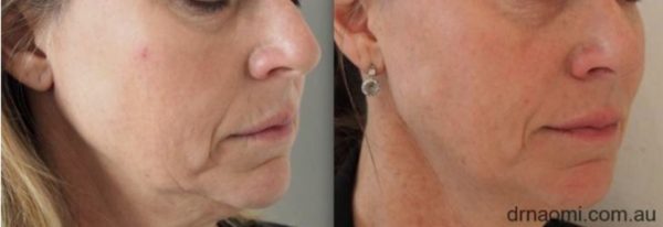 Treatment for jowls and lower face