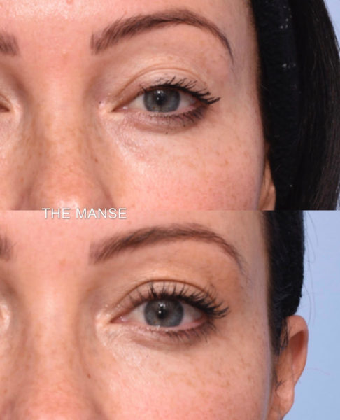 Treatments for under eye hollowing
