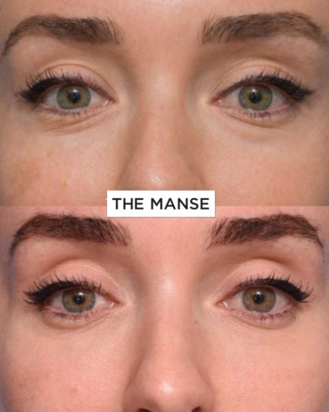 Under eye skin tightening using multiple methods 