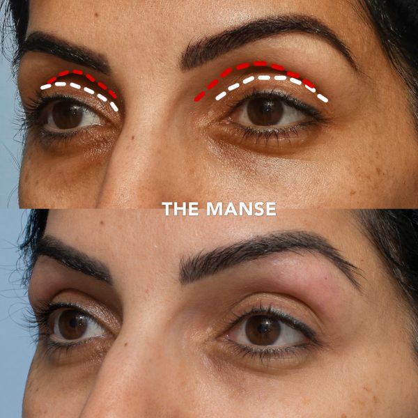 Upper eyelid rejuvenation