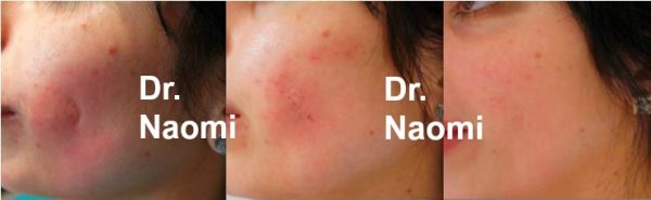 Scar Before Image 2: Immediately after treatment to scar Image 3: 2 weeks after treatment