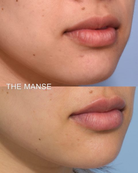 before and after lip and lower face treatments