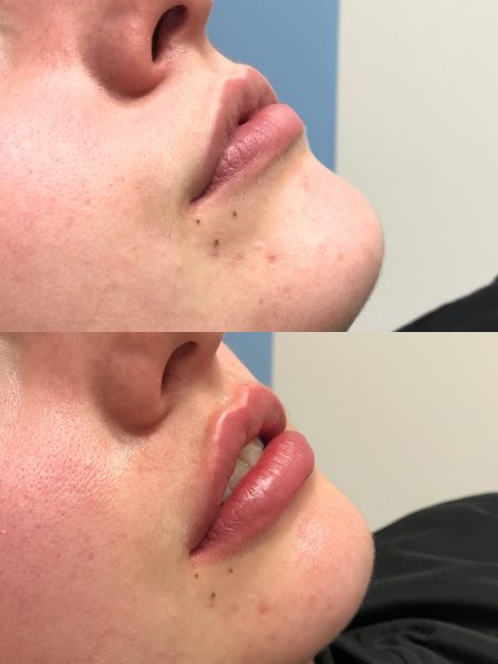 Before and after lip treatments
