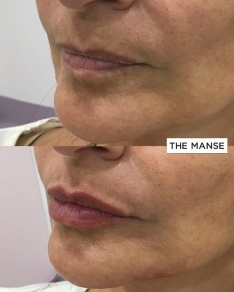 Before and after lips