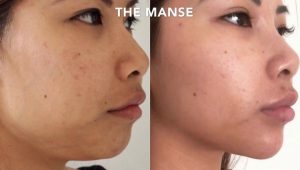 before and after multiple treatments