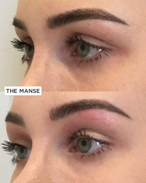 eyelid treatments