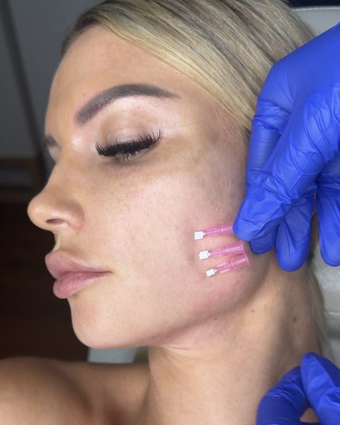 Face Biostimulation