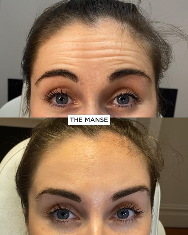 Forehead wrinkle gallery