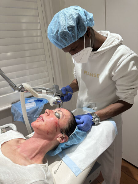 Fractional laser sydney