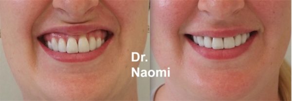 Gummy smile before and after