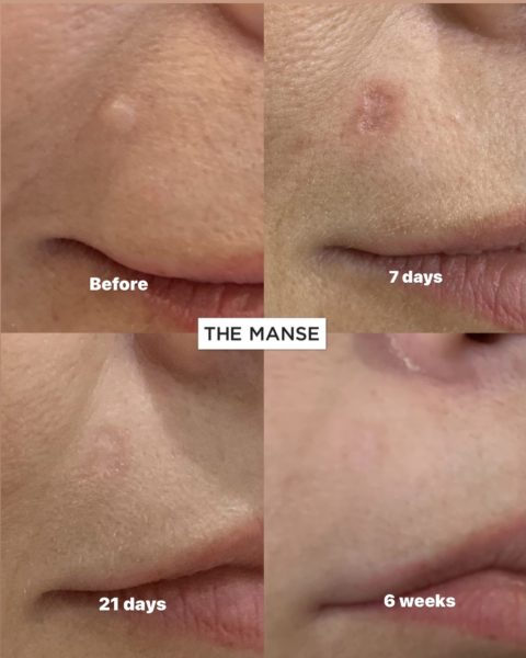 Mole removal before and after