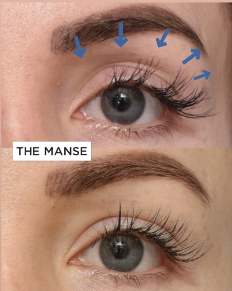 Upper eyelid fat loss