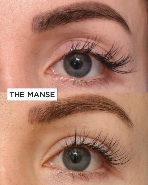 Upper eyelid hollowing