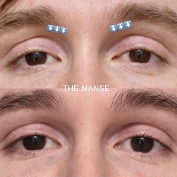 Before and after upper eyelid treatments. This has made the eyelid curve parallel to the lash line