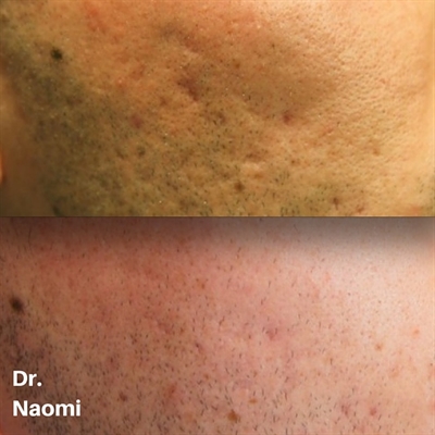 Before and after treatments for acne scarring, including fractional laser, skinbooster and qswitched laser and volume treatments