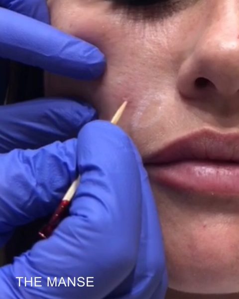 TCA CROSS for acne scarring