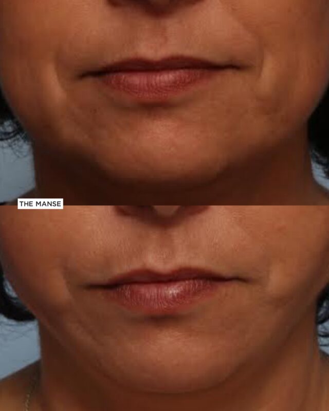 Lower face threadlift before and after