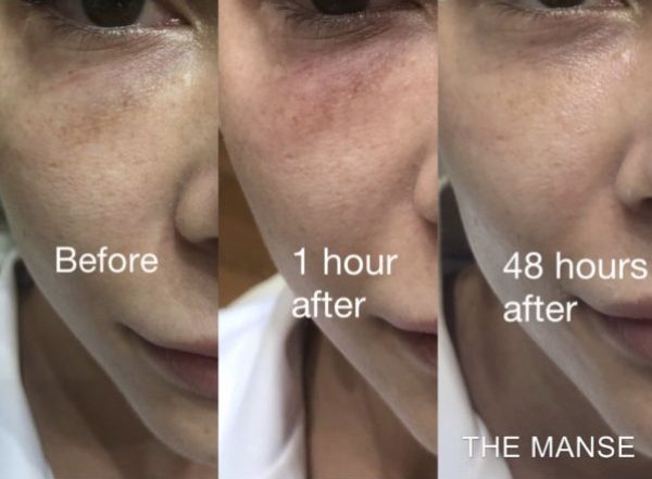 Before, 1 hour after dissolving treatment and 48 hours after dissolving treatment. Results show improvement in lump and dark area (which looked like pigmentation, but was Tyndall effect)