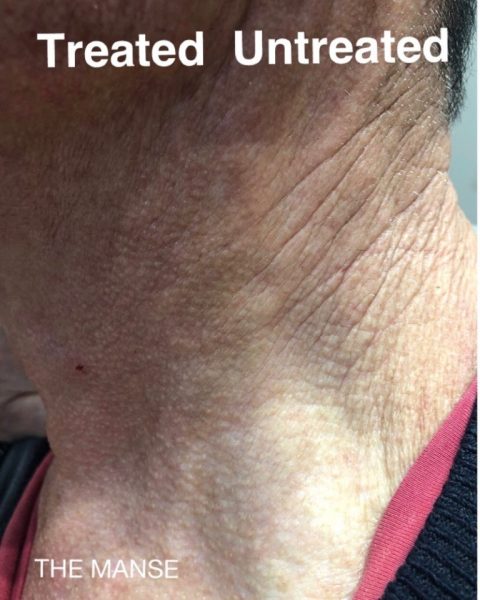 Before and after skin treatments for neck wrinkles including biostimulator, RF microneedling, skinbooster and IPL