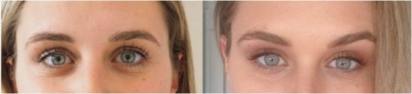 Before and after brow lift