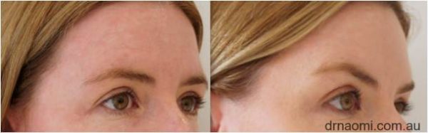 Before and after brow lift