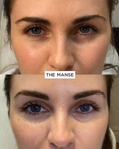 Before and after browlift