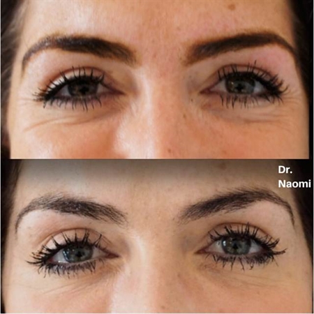 Before and after browlift