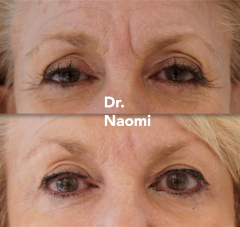 Before and after browlift and frown treatment
