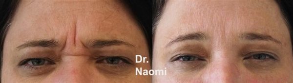 Before and after frown line treatment