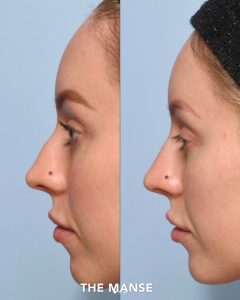 Before and after nose and other treatments