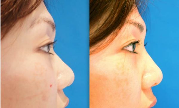 Before and after nose bridge lifting, 1 treatment