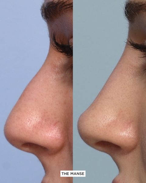 Before and after nose lifting