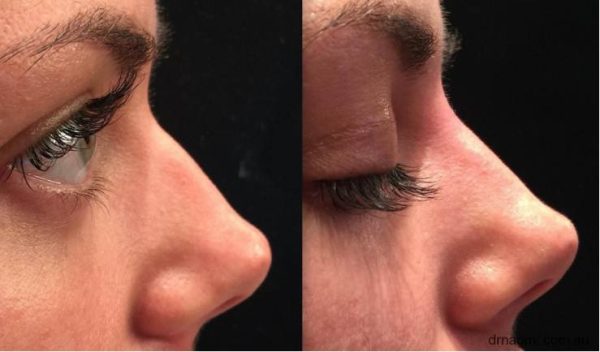 Before and after nose treatment