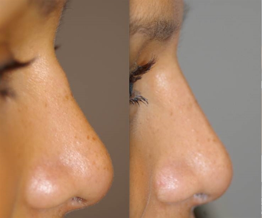 Before and after nose treatment to disguise bump in nose from previous nose surgery