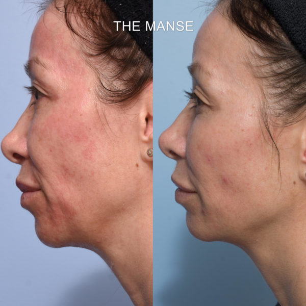 Before and after threadlift