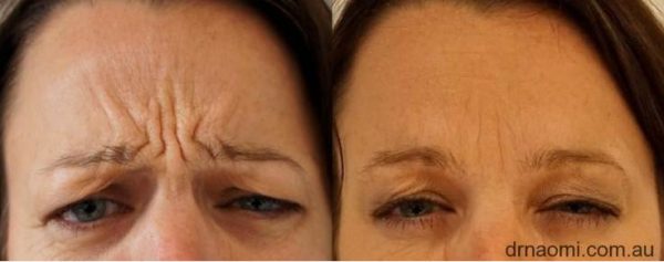 Before and after treatment for frown lines