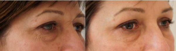 Browlift before and after