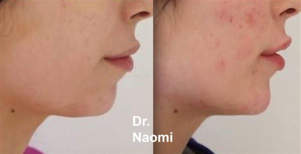Chin Treatment