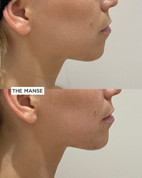 Chin Treatment Subtle Change