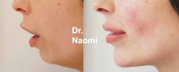 Chin and Lips Treatment