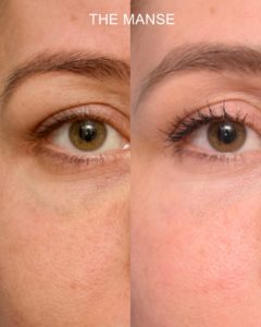 Before and after laser blue vein removal (and other treatments)