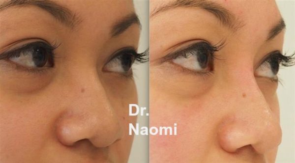 Nose bridge treatment before and after