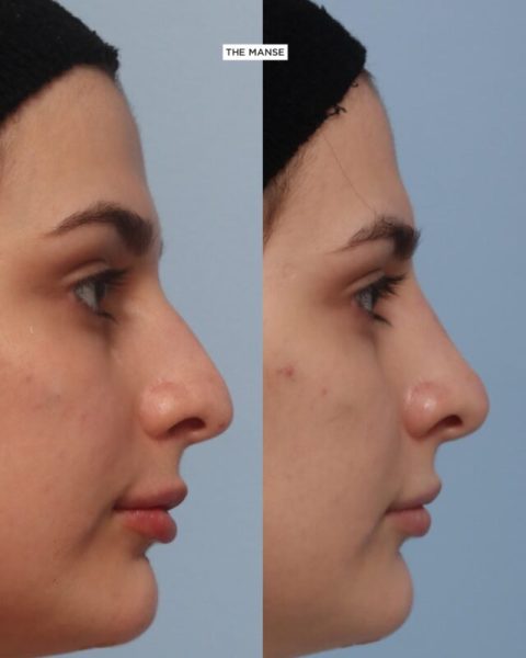 Nose treatment before and after