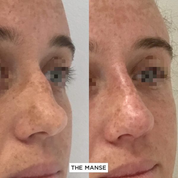 Nose treatment before and after