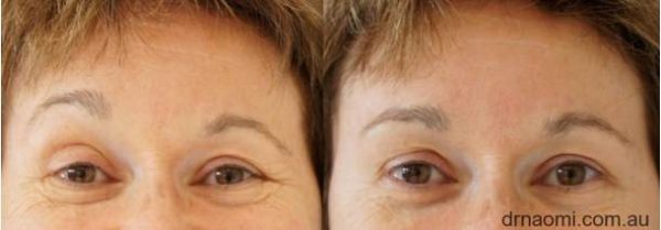 before and after treatment of eyebrow asymmetry