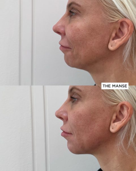 chin treatment