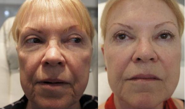 Before and After Full Face Rejuvenation