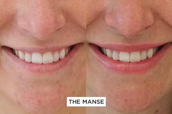Before and After Lip Treatment