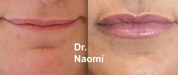 Before and After Lip Treatment
